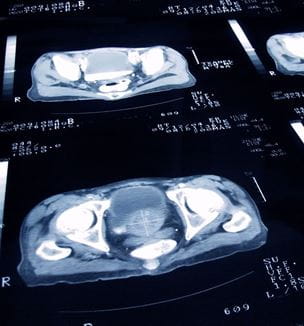 Prostate cancer scan
