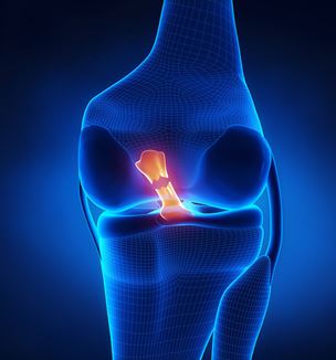 ACL tear illustration