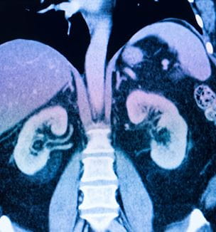 Kidney scan