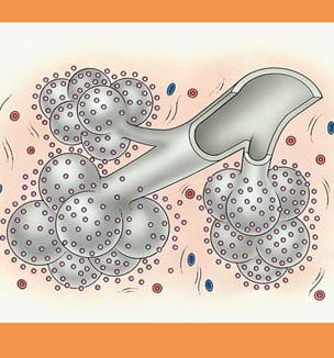 Idiopathic pulmonary fibrosis illustration