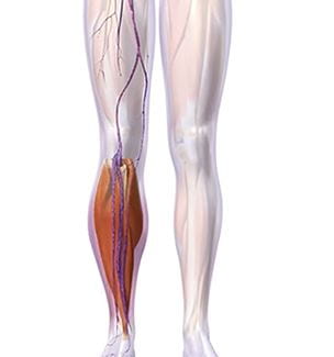 Venovalve illustration