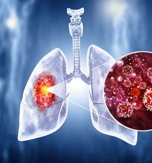 Lung cancer illustration