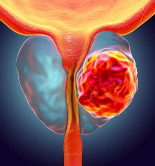 Prostate Cancer 3D illustration