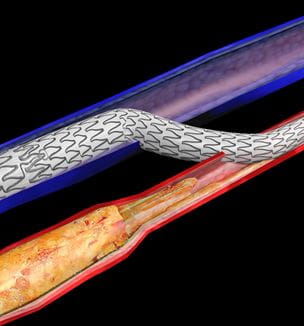 LimFlow crossing stent image