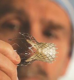 transcatheter aortic valve replacement