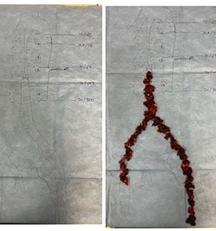 congenital anomaly during thrombectomy procedure
