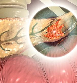 Pancreatic Cancer illustration
