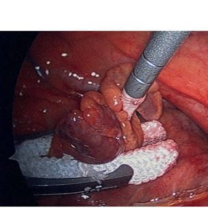 AtriClip device