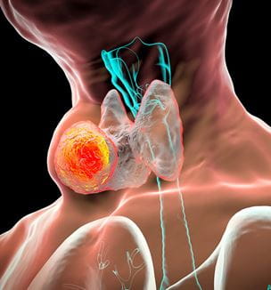Getty image of thyroid gland tumor