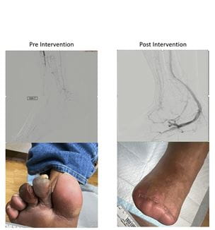 LimFlow procedure pre and post results