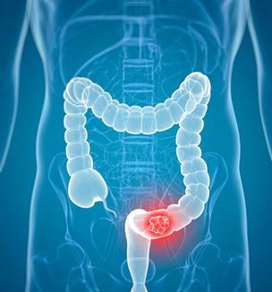 Getty image illustration of colorectal cancer