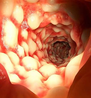 Crohns illustration