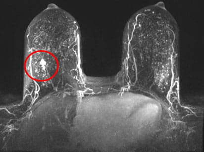 Abbreviated breast MRI scan