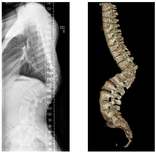 Pre-surgery acute kyphosis