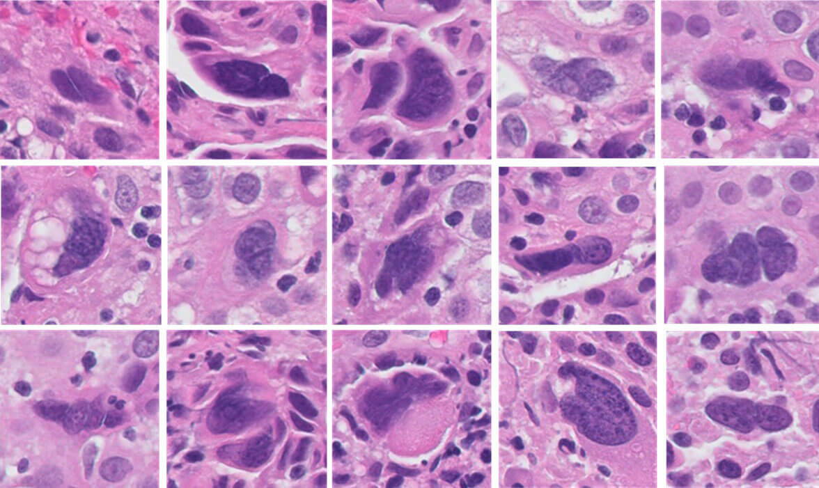 AI tumor response image