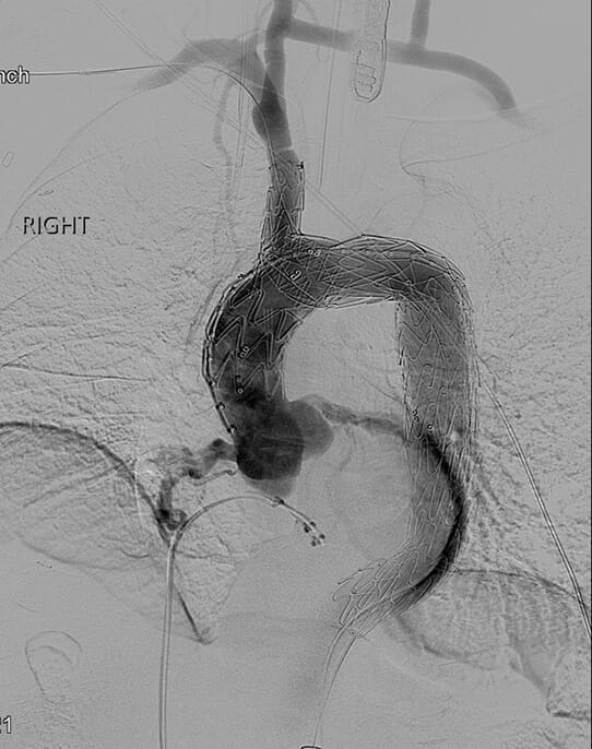 Aortic arch stent device in place shown on scan