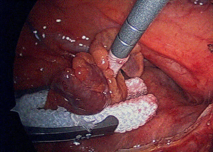 AtriCure Pro-V 35mm AtriClip in place at the base of the left atrial appendage.