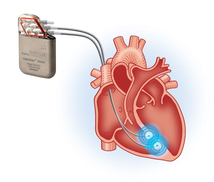 Cardiac Contractility Modulation
