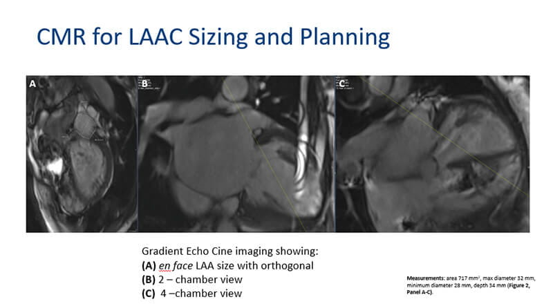 MRI images obtained before procedure to plan size