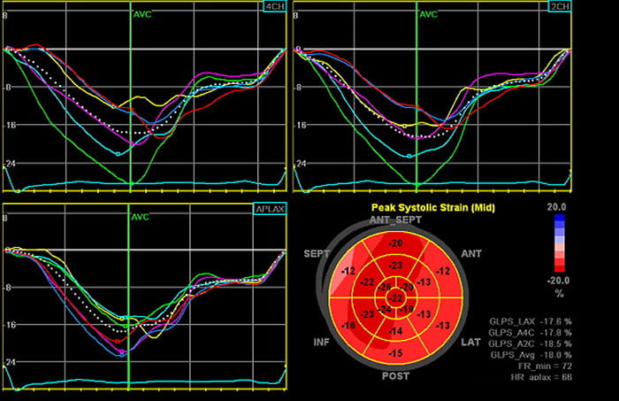 Novel markers like strain are more sensitive parameters of heart function, which help identify chemotherapy-induced cardiotoxicity early