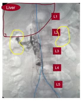 Congenital anomaly before intervention