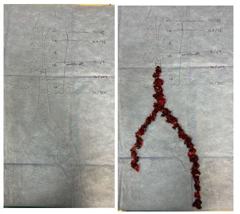 Congenital anomaly during thrombectomy procedure