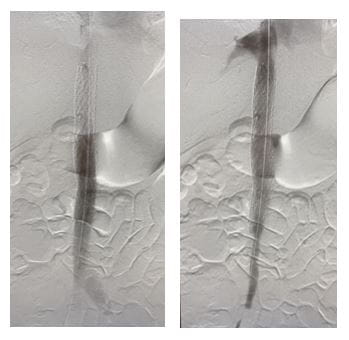 Congenital anomaly after stenting