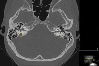 CT Scan of EVA within right inner ear
