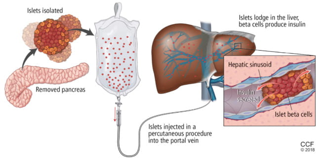 Reprinted with permission from: Rodeman K, Hatipoglu B. Beta-cell therapies for type 1 diabetes: Transplants and bionics