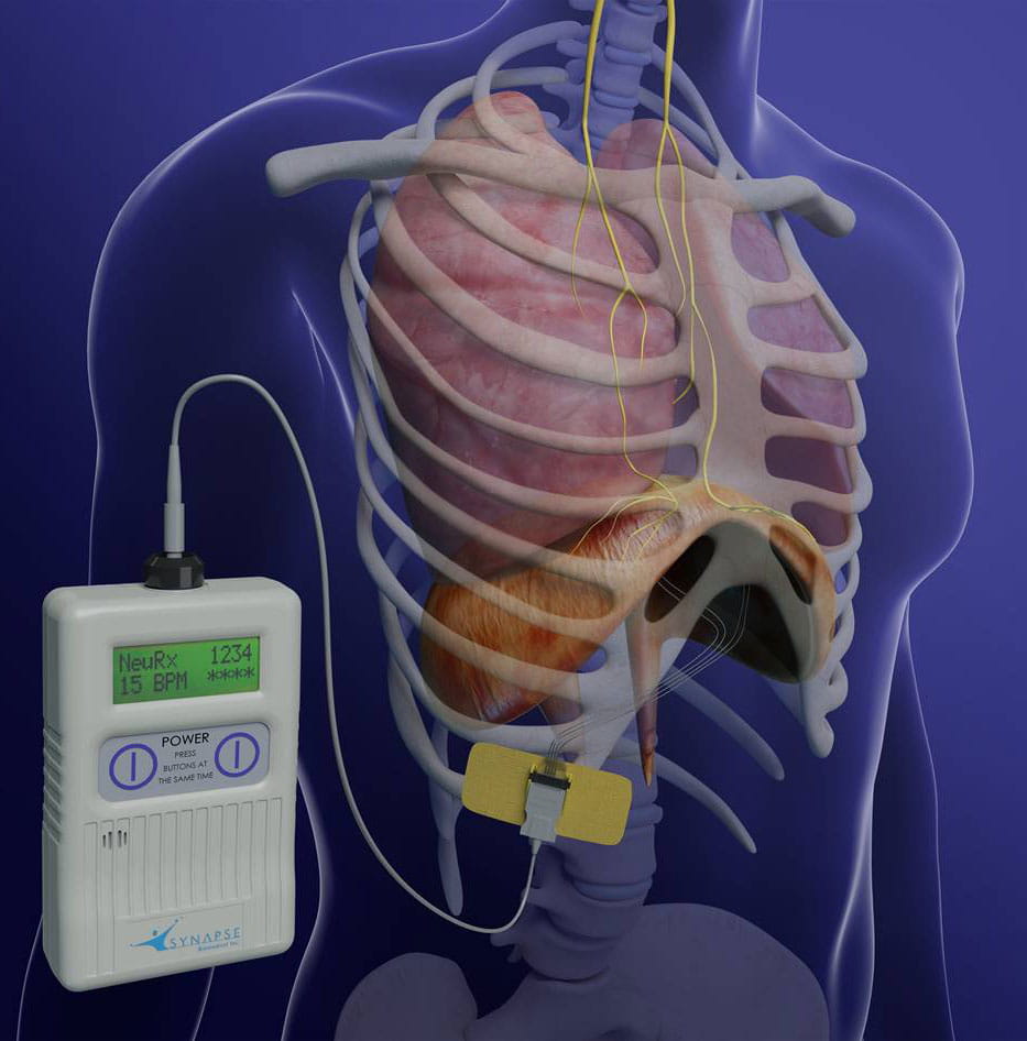 Diaphragm Pacing