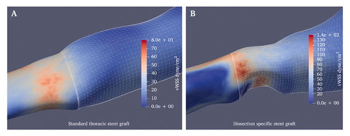 Dissection specific stent graft image