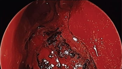 Endoscopic view of the left nasal cavity.