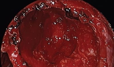 Post resection view.