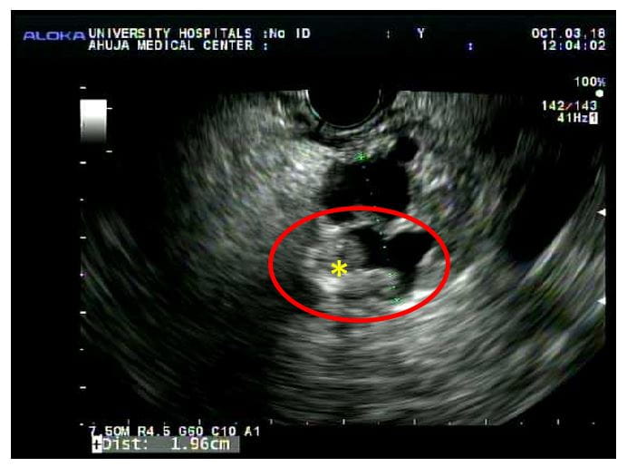 Pictured: a 56-year-old man who had a whipple for an intraductal papillary mucinous tumor with a solid nodule. He went home five days after the whipple with no complications.