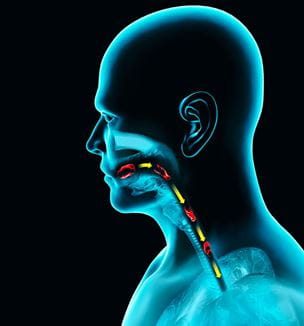 lllustration of Disorders of swallowing, dysphagia.