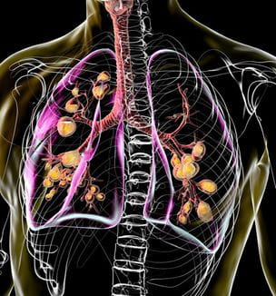 Getty image of lungs with cystic fibrosis