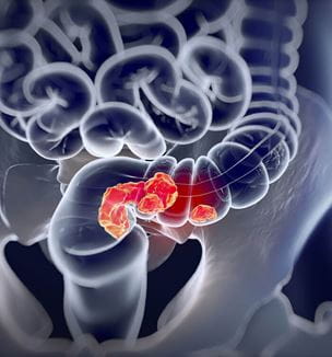 Getty colorectal cancer illustration