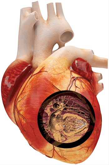 Percutaneous Ventricular Restoration Device