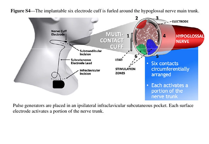 Implantable six electrode device