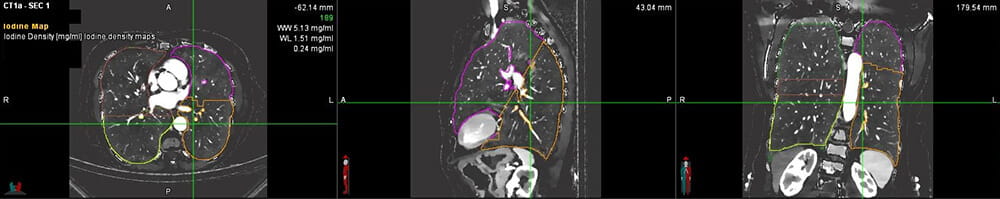 Dual Energy Computed Tomography (DECT) scan