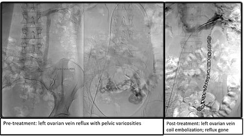 Left ovarian vein coil embolization