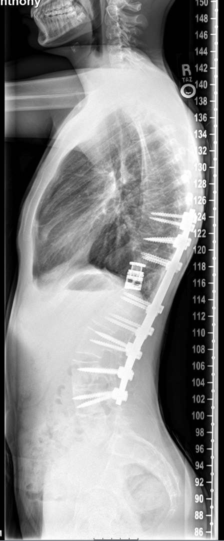 Kyphosis corrected post-surgery