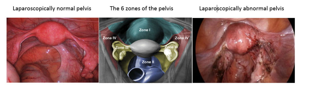 Laproscopic Pelvis Image