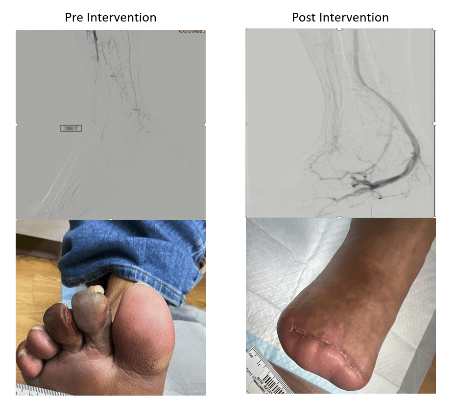 LimFlow procedure pre- and post-intervention