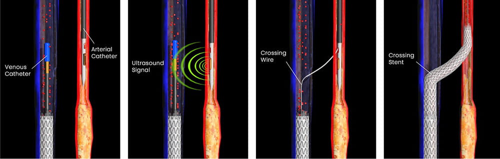 LimFlow procedure graphic