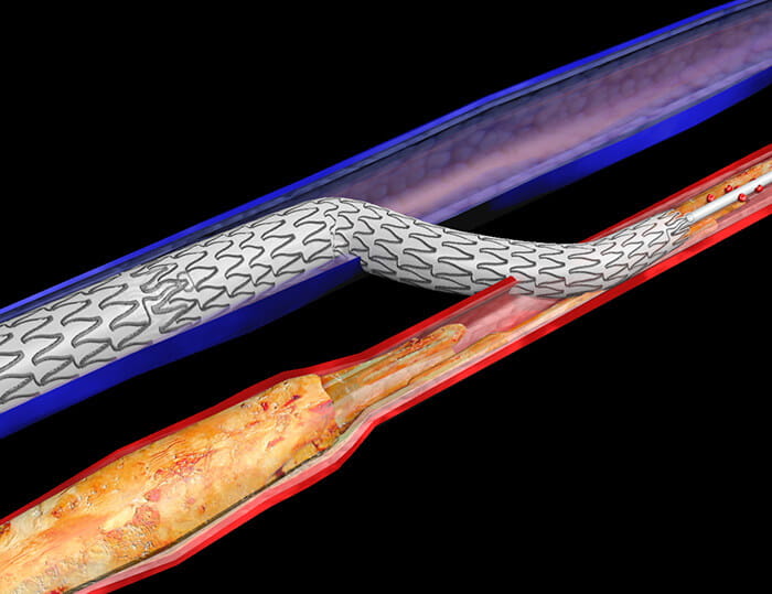 LimFlow crossing stent image