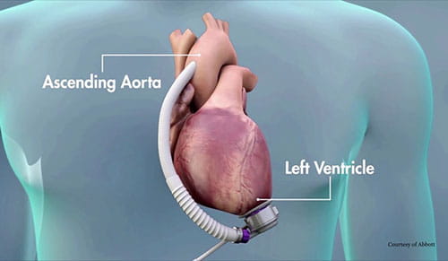LVAD device internal illustration