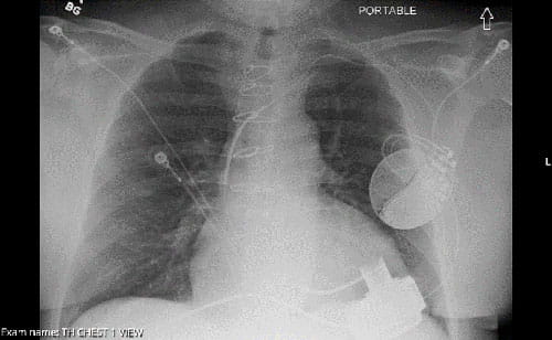 LVAD device xray