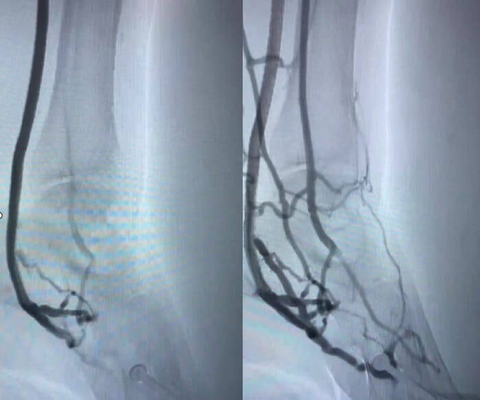 LimFlow scan before and after