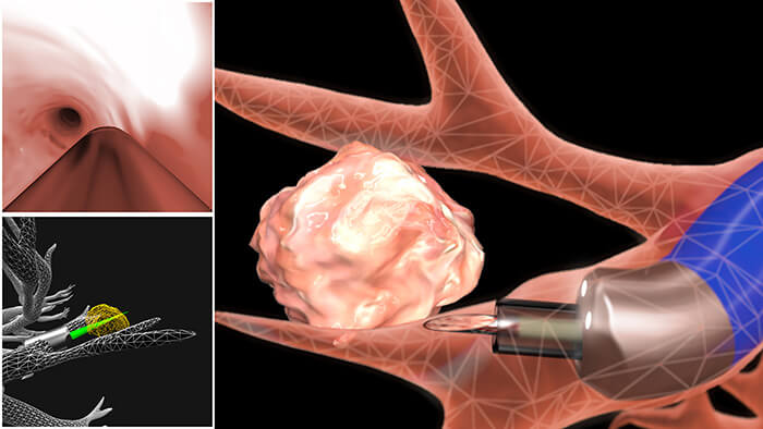 Monarch Bronchoscopy - Close up view of needle taking biopsy of Nodule